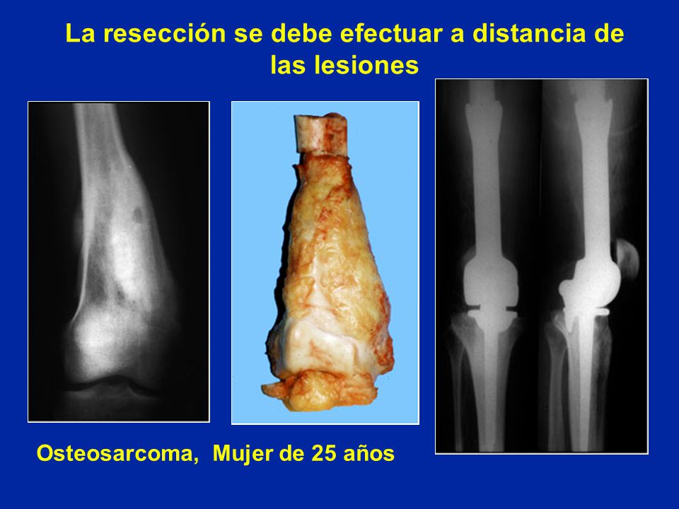 La resección se debe efectuar a distancia de las lesiones