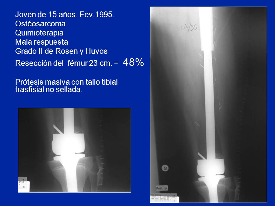 Joven de 15 años. Fev Ostéosarcoma. Quimioterapia. Mala respuesta. Grado II de Rosen y Huvos.