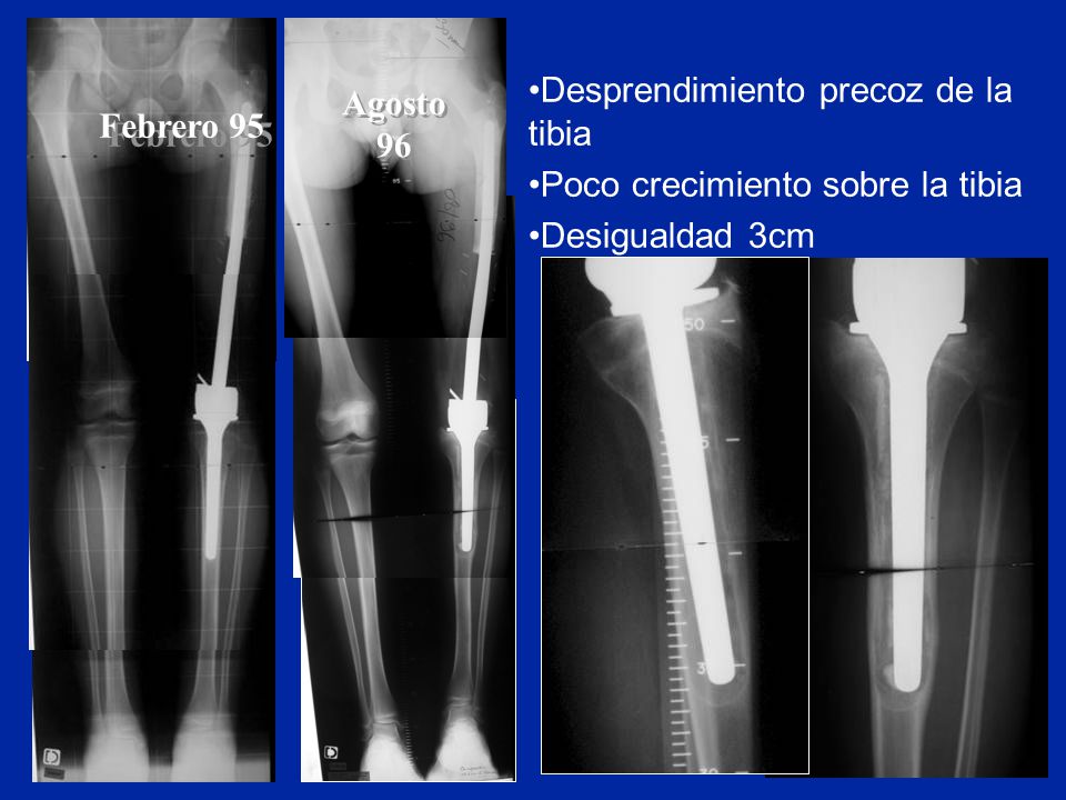 Agosto 96 Desprendimiento precoz de la tibia. Poco crecimiento sobre la tibia.