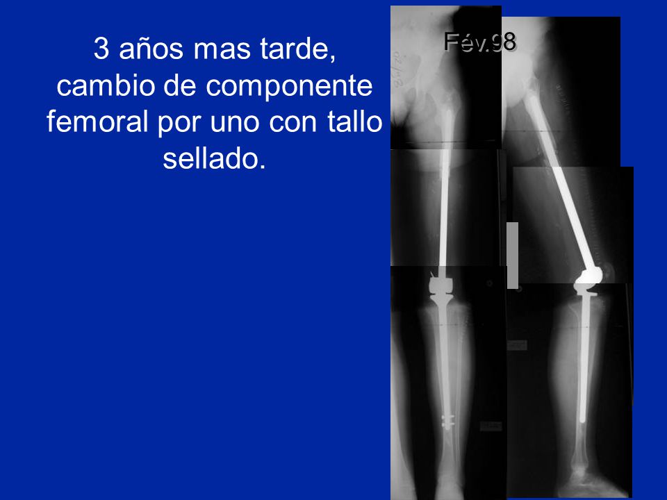 Fév.98 3 años mas tarde, cambio de componente femoral por uno con tallo sellado.