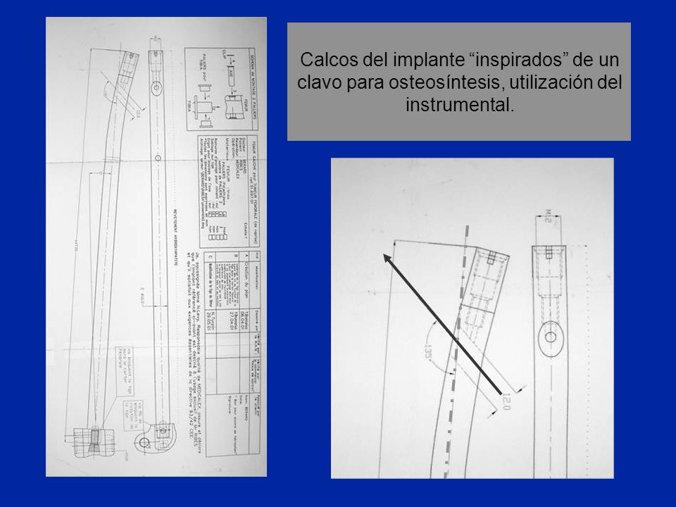 Calcos del implante inspirados de un clavo para osteosíntesis, utilización del instrumental.