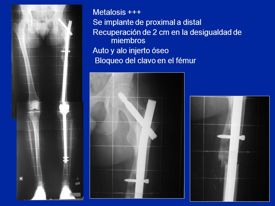 Metalosis +++ Se implante de proximal a distal. Recuperación de 2 cm en la desigualdad de miembros.