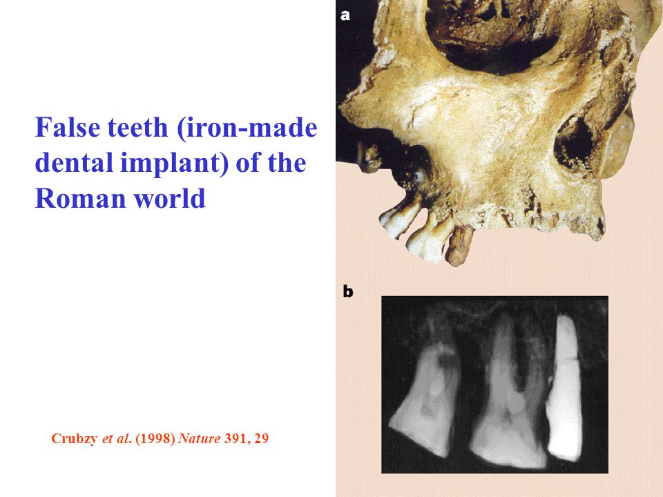 False teeth (iron-made dental implant) of the Roman world