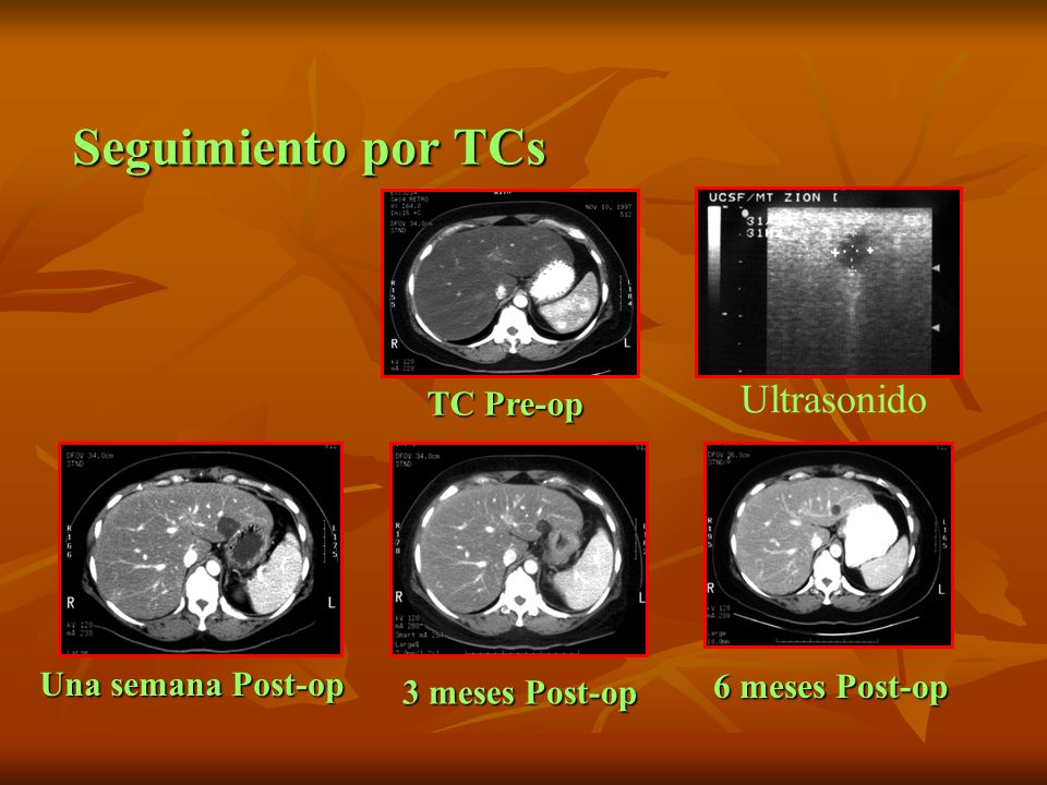 Seguimiento por TCs Ultrasonido TC Pre-op Una semana Post-op