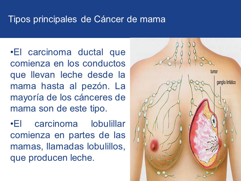 Tipos principales de Cáncer de mama