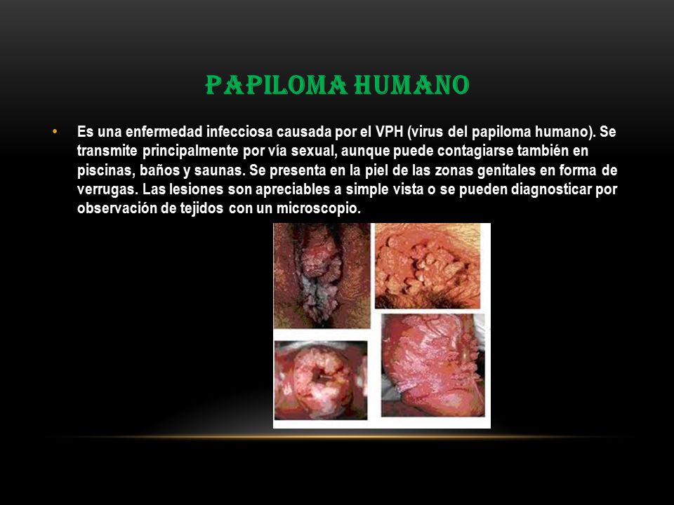 Papiloma humano