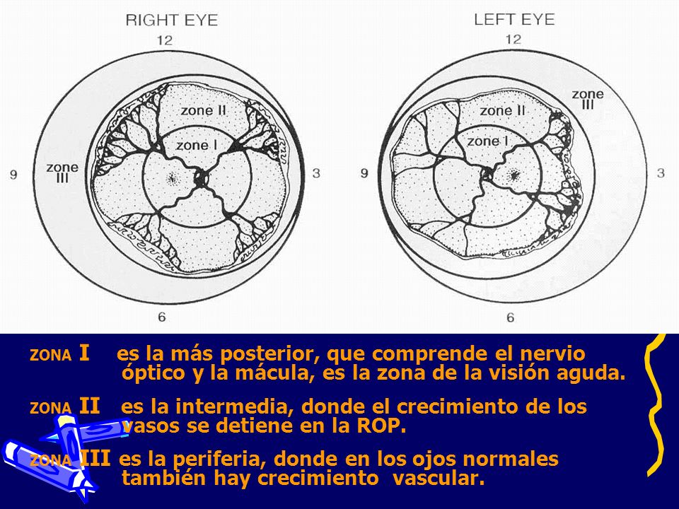 ZONA I es la más posterior, que comprende el nervio óptico y la mácula, es la zona de la visión aguda.