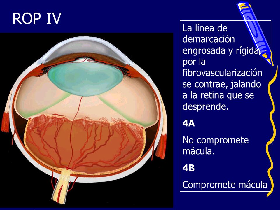 ROP IV La línea de demarcación engrosada y rígida por la fibrovascularización se contrae, jalando a la retina que se desprende.