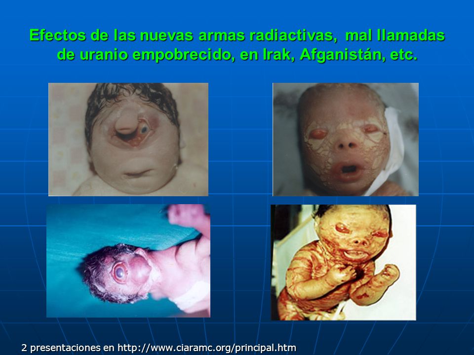Efectos de las nuevas armas radiactivas, mal llamadas de uranio empobrecido, en Irak, Afganistán, etc.