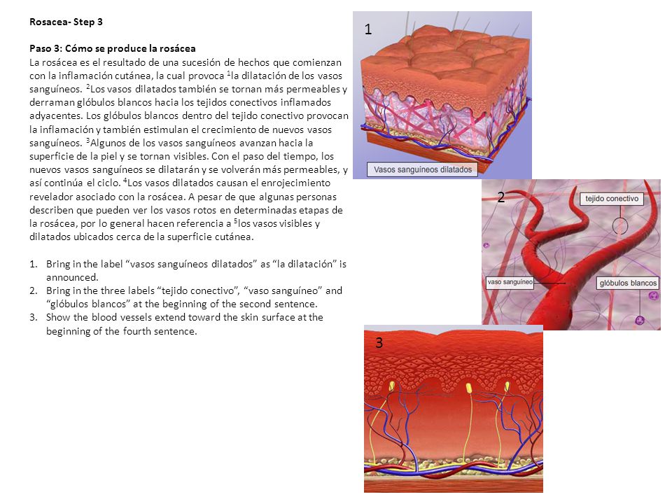 1 2 3 Rosacea- Step 3 Paso 3: Cómo se produce la rosácea