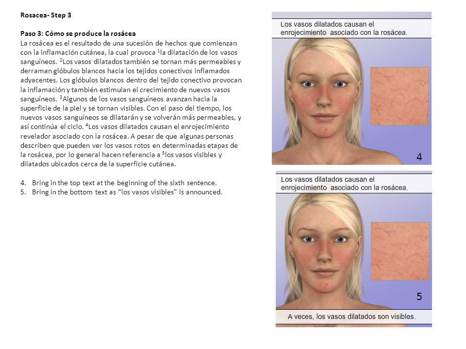 4 5 Rosacea- Step 3 Paso 3: Cómo se produce la rosácea