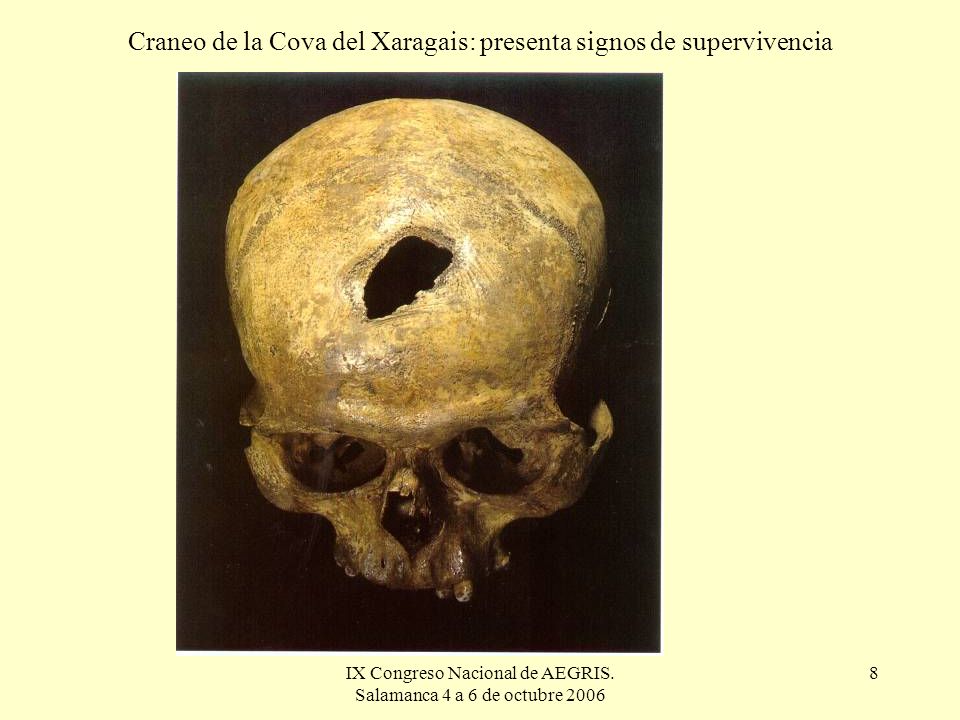 Craneo de la Cova del Xaragais: presenta signos de supervivencia