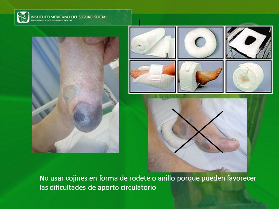 | No usar cojines en forma de rodete o anillo porque pueden favorecer las dificultades de aporto circulatorio.