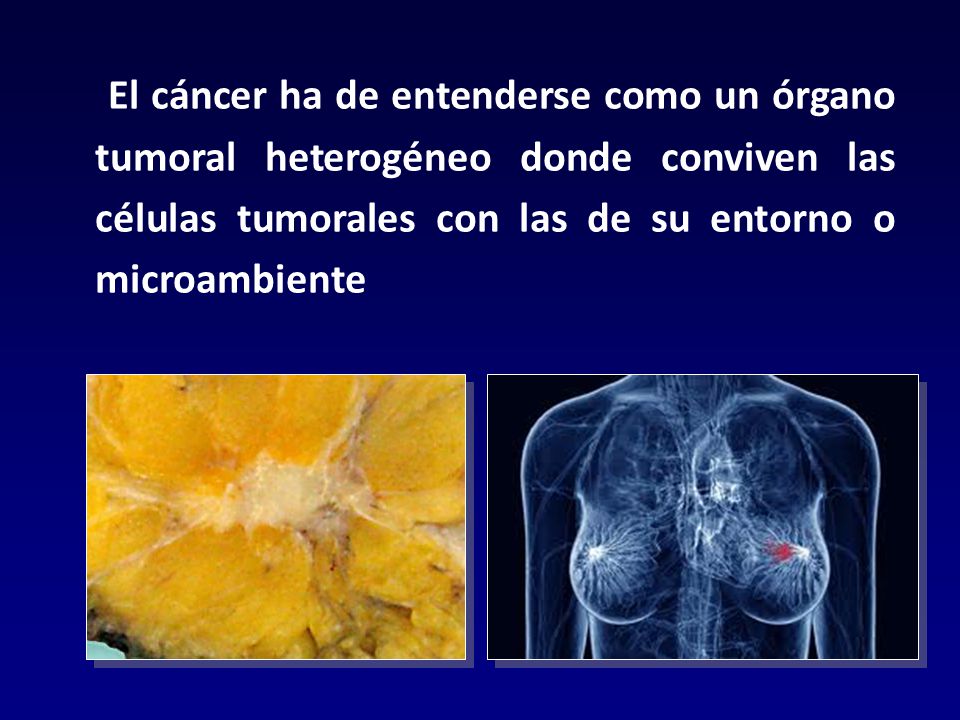El cáncer ha de entenderse como un órgano tumoral heterogéneo donde conviven las células tumorales con las de su entorno o microambiente
