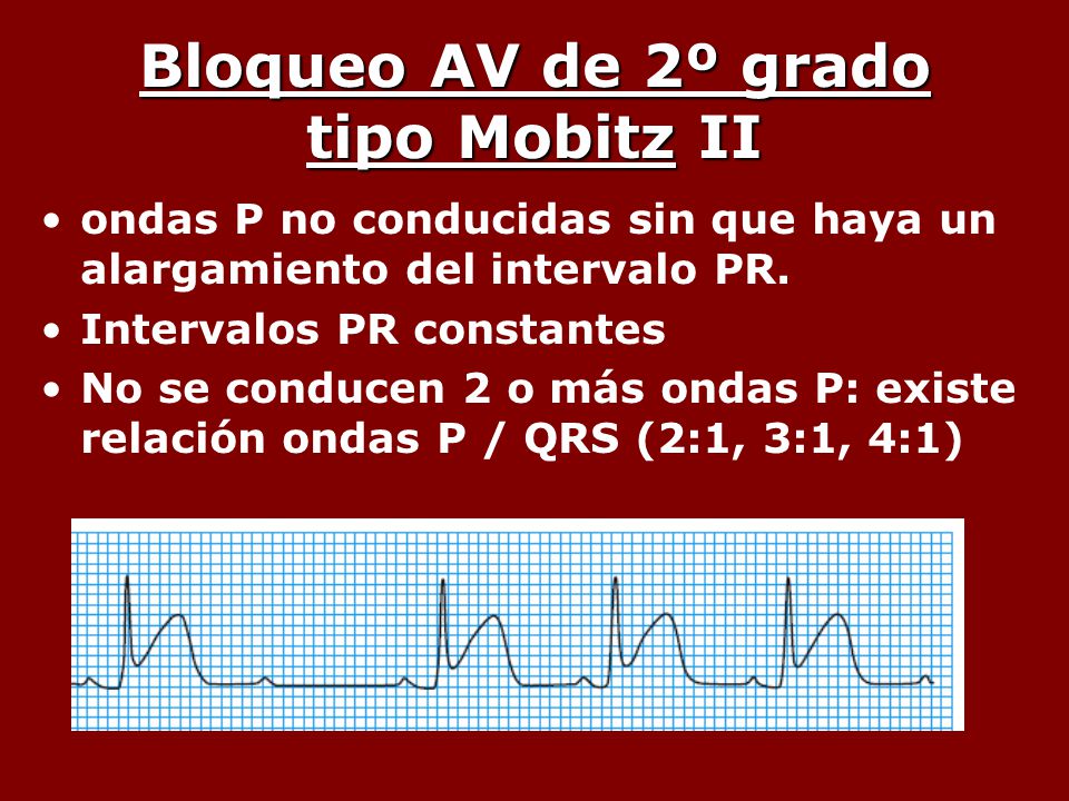 Bloqueo AV de 2º grado tipo Mobitz II