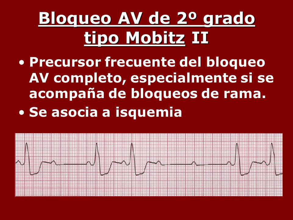 Bloqueo AV de 2º grado tipo Mobitz II