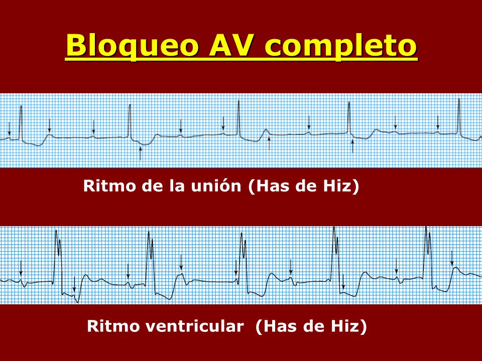 Bloqueo AV completo Ritmo de la unión (Has de Hiz)