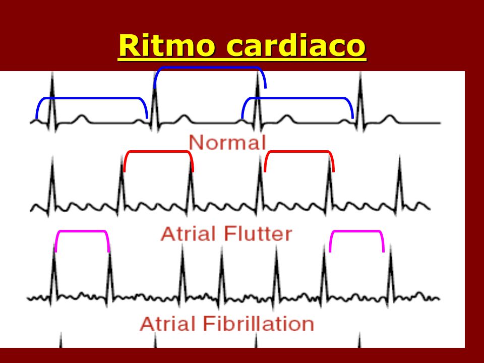 Ritmo cardiaco Regular – irregular regular: se repite el patron - irregular : no hay patrón
