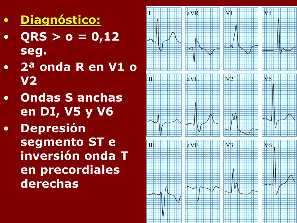Diagnóstico: QRS > o = 0,12 seg. 2ª onda R en V1 o V2. Ondas S anchas en DI, V5 y V6.
