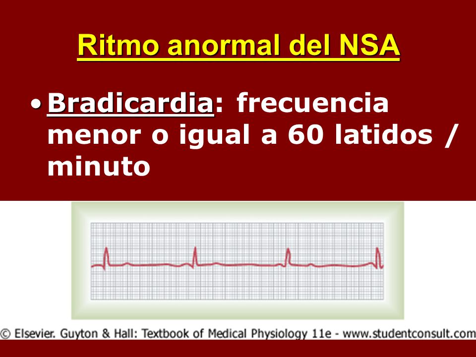 Ritmo anormal del NSA Bradicardia: frecuencia menor o igual a 60 latidos / minuto