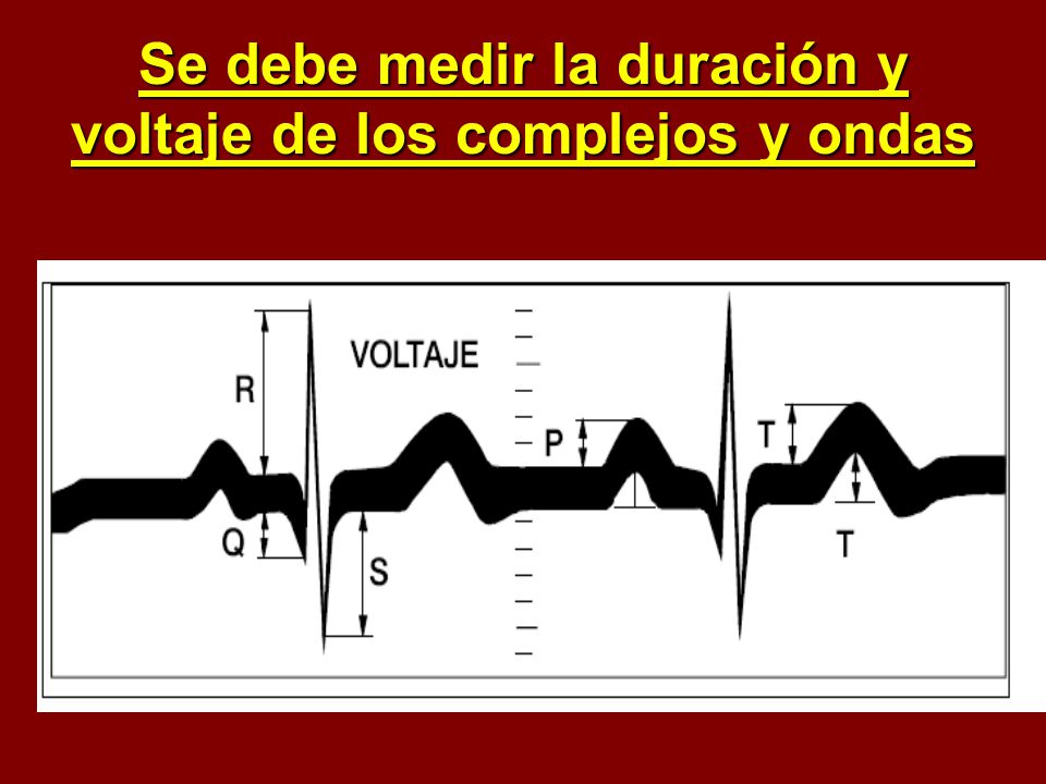 Se debe medir la duración y voltaje de los complejos y ondas