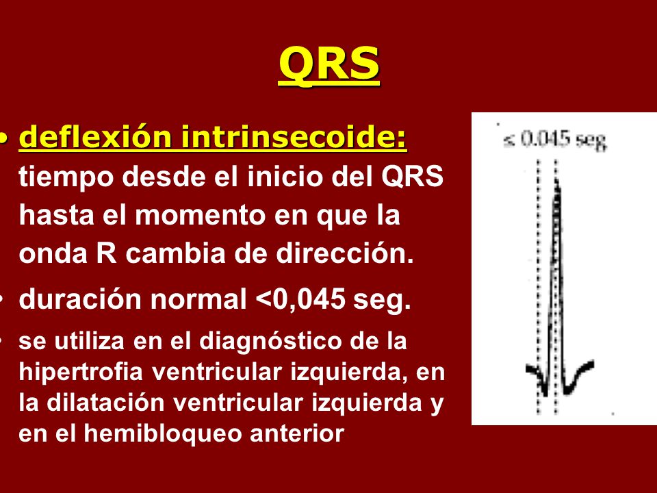 QRS deflexión intrinsecoide: tiempo desde el inicio del QRS hasta el momento en que la onda R cambia de dirección.