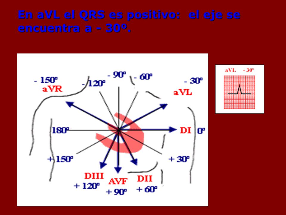 En aVL el QRS es positivo: el eje se encuentra a - 30º.