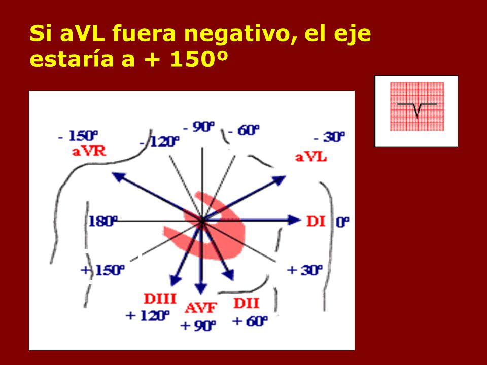 Si aVL fuera negativo, el eje estaría a + 150º