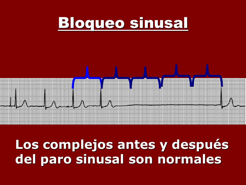 Bloqueo sinusal Los complejos antes y después del paro sinusal son normales