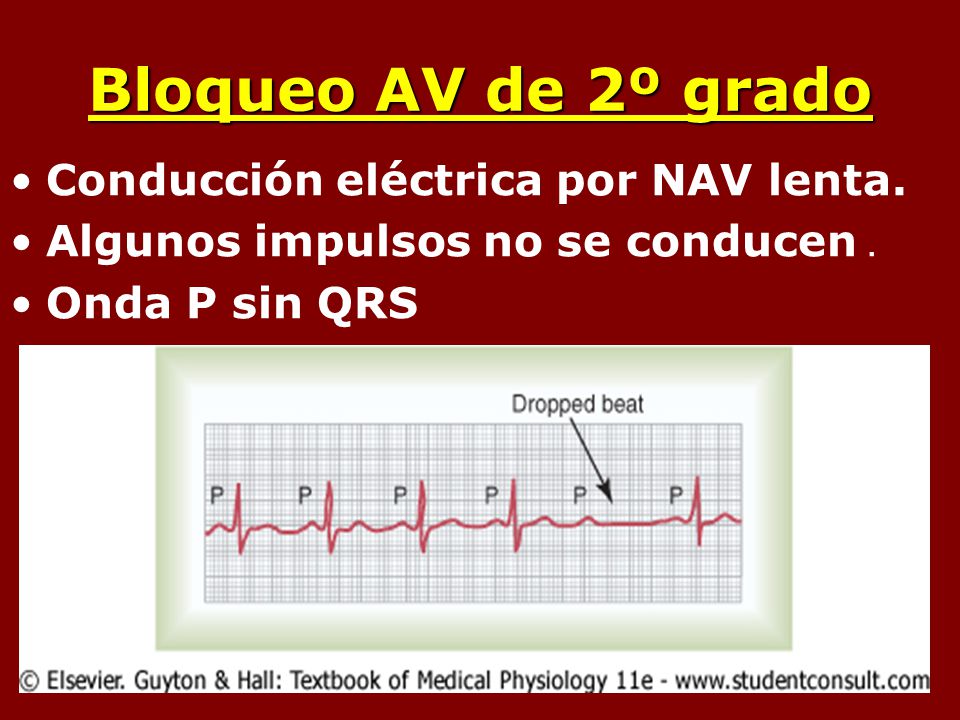 Bloqueo AV de 2º grado Conducción eléctrica por NAV lenta.