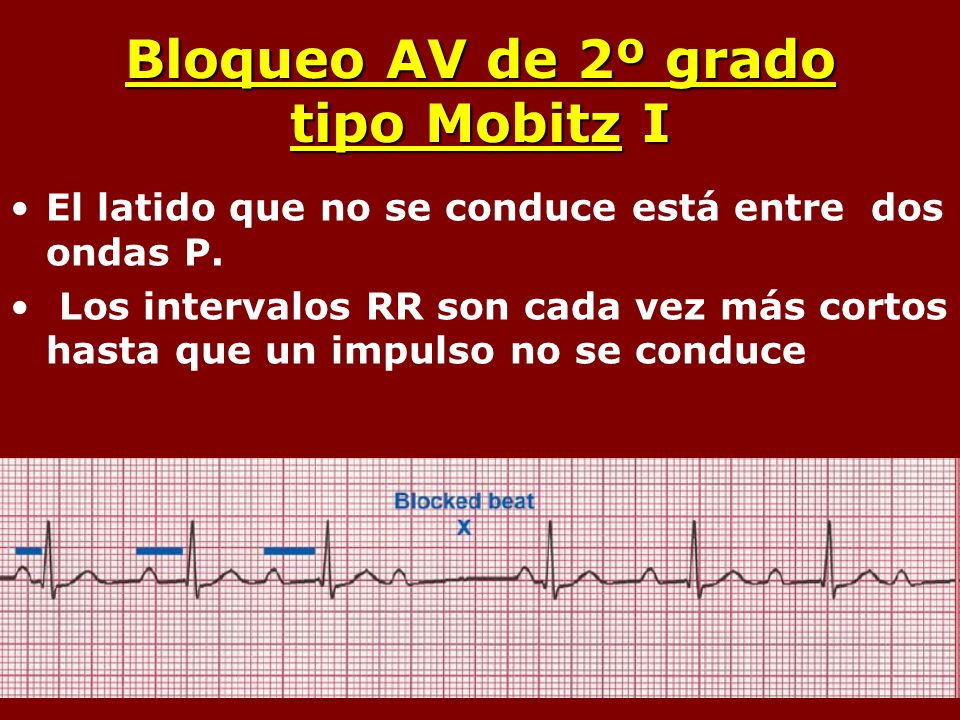 Bloqueo AV de 2º grado tipo Mobitz I