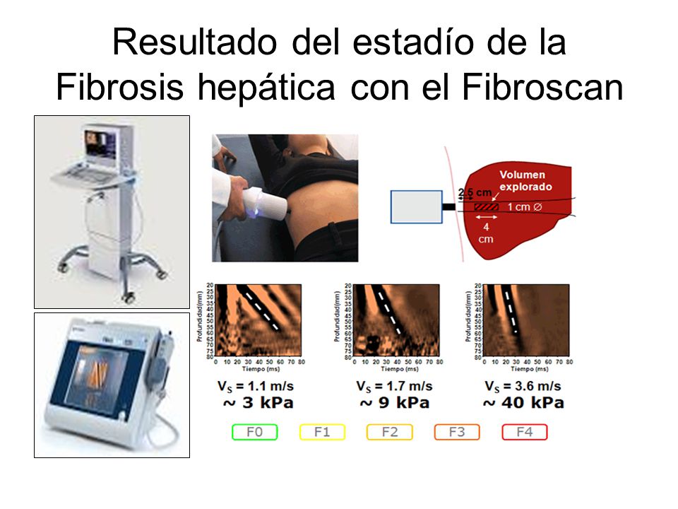 Resultado del estadío de la Fibrosis hepática con el Fibroscan