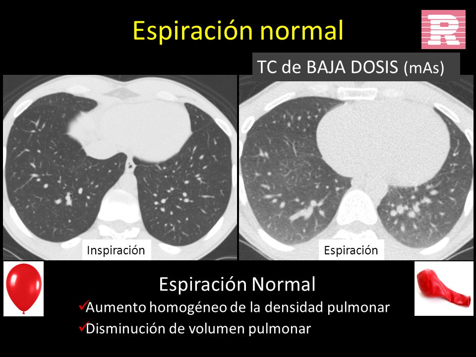 Espiración normal Espiración Normal TC de BAJA DOSIS (mAs)