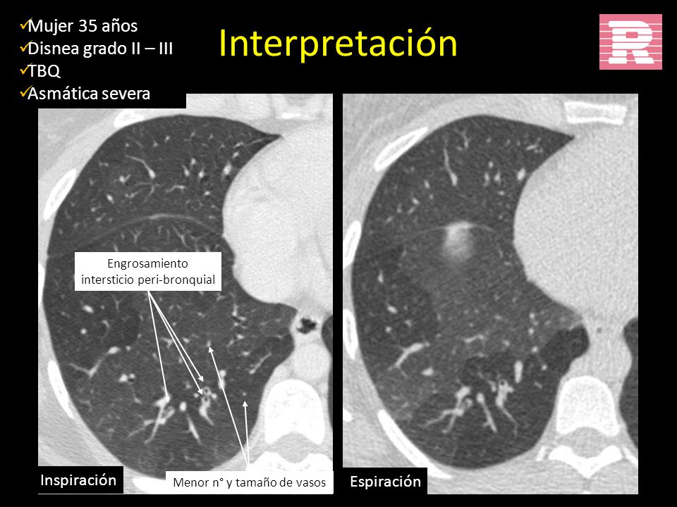 Interpretación Mujer 35 años Disnea grado II – III TBQ Asmática severa