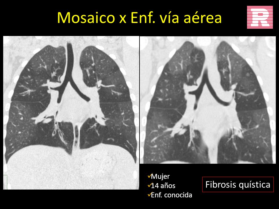 Mosaico x Enf. vía aérea Mujer 14 años Enf. conocida Fibrosis quística