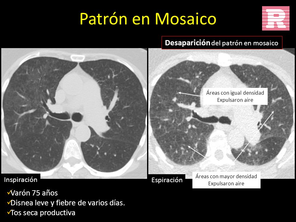 Patrón en Mosaico Desaparición del patrón en mosaico Varón 75 años