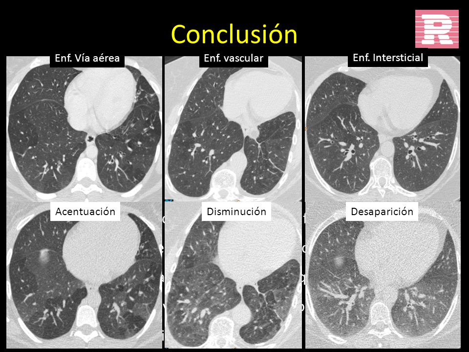 Conclusión Enf. Vía aérea. Enf. vascular. Enf. Intersticial. Patrón con aéreas hipo e hiperdensas de diferenciación sutil.