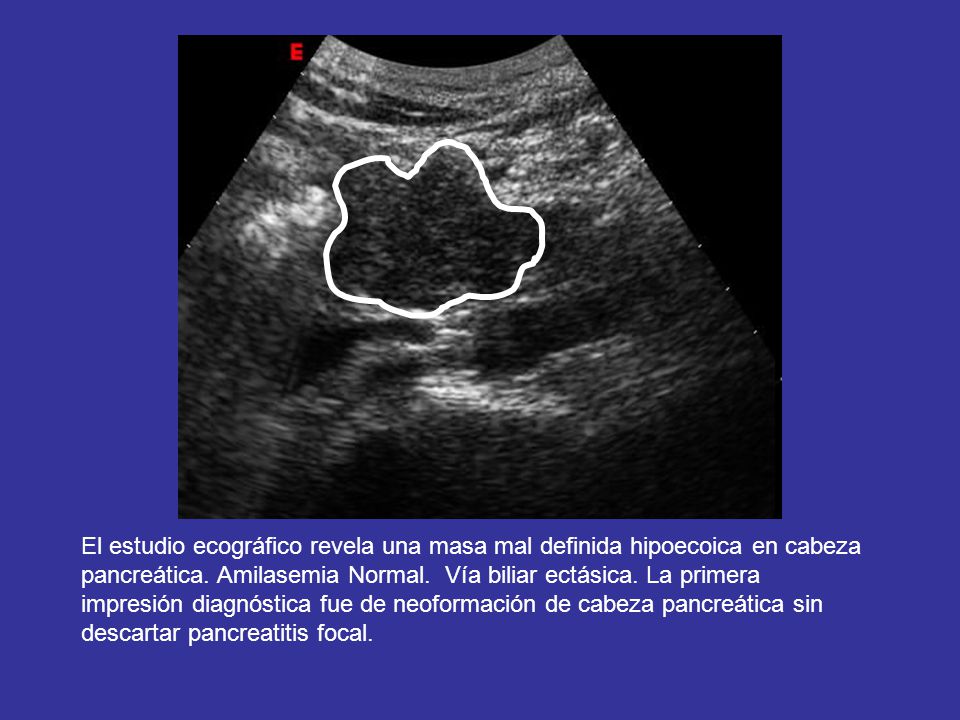 Paciente diagnosticado de colangitis esclerosante primaria, con antigua derivacion biliodigestiva, debuta con un cuadro de dolor abdominal progresivo, de meses de evolución ahora agravado,con ictericia subconjuntival. Se sospecha estenosis de vía biliar y se indica ecografía abdominal.