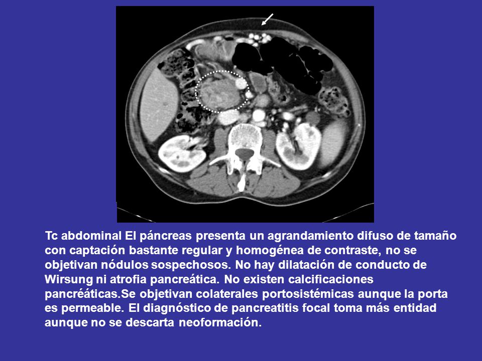 Tc abdominal El páncreas presenta un agrandamiento difuso de tamaño con captación bastante regular y homogénea de contraste, no se objetivan nódulos sospechosos.
