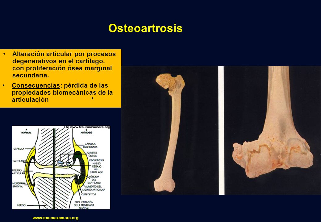 Osteoartrosis Alteración articular por procesos degenerativos en el cartílago, con proliferación ósea marginal secundaria.