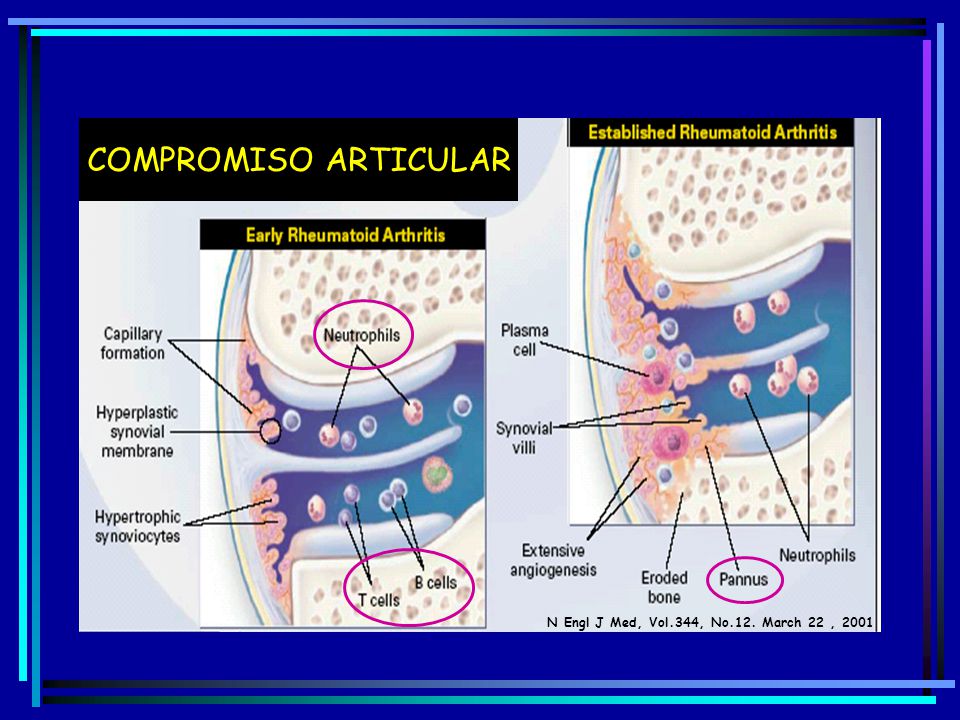 COMPROMISO ARTICULAR N Engl J Med, Vol.344, No.12. March 22 , 2001