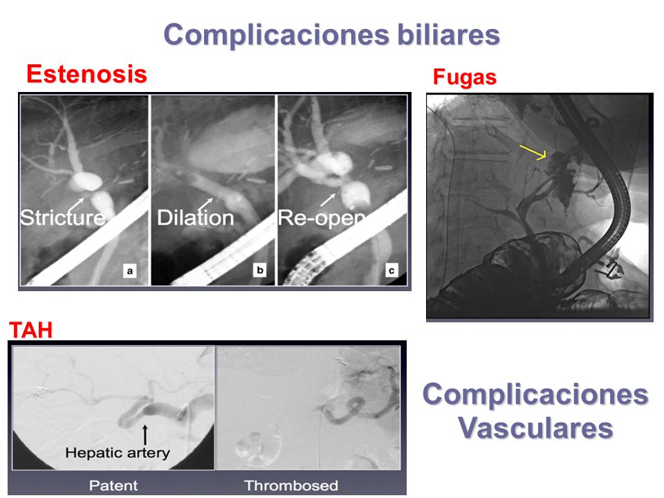 Complicaciones biliares Complicaciones Vasculares