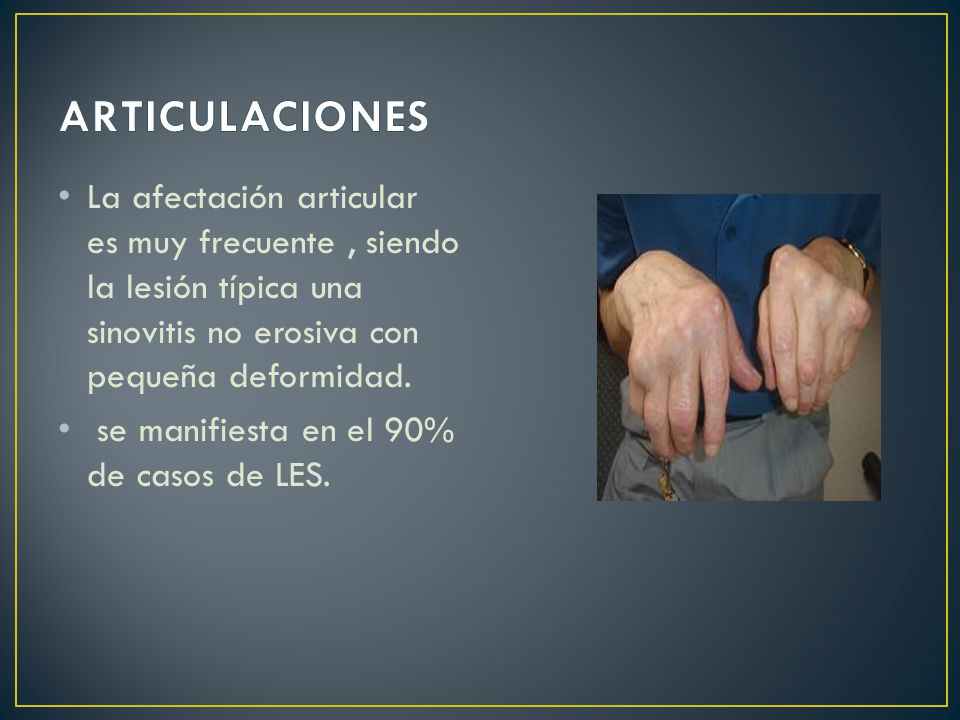 ARTICULACIONES La afectación articular es muy frecuente , siendo la lesión típica una sinovitis no erosiva con pequeña deformidad.