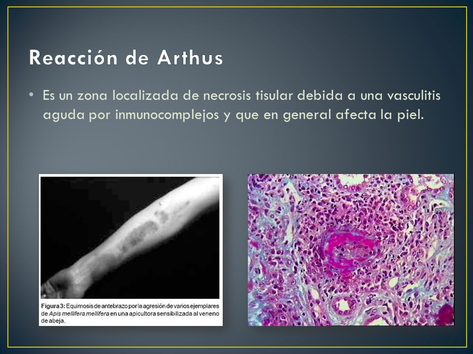 Reacción de Arthus Es un zona localizada de necrosis tisular debida a una vasculitis aguda por inmunocomplejos y que en general afecta la piel.