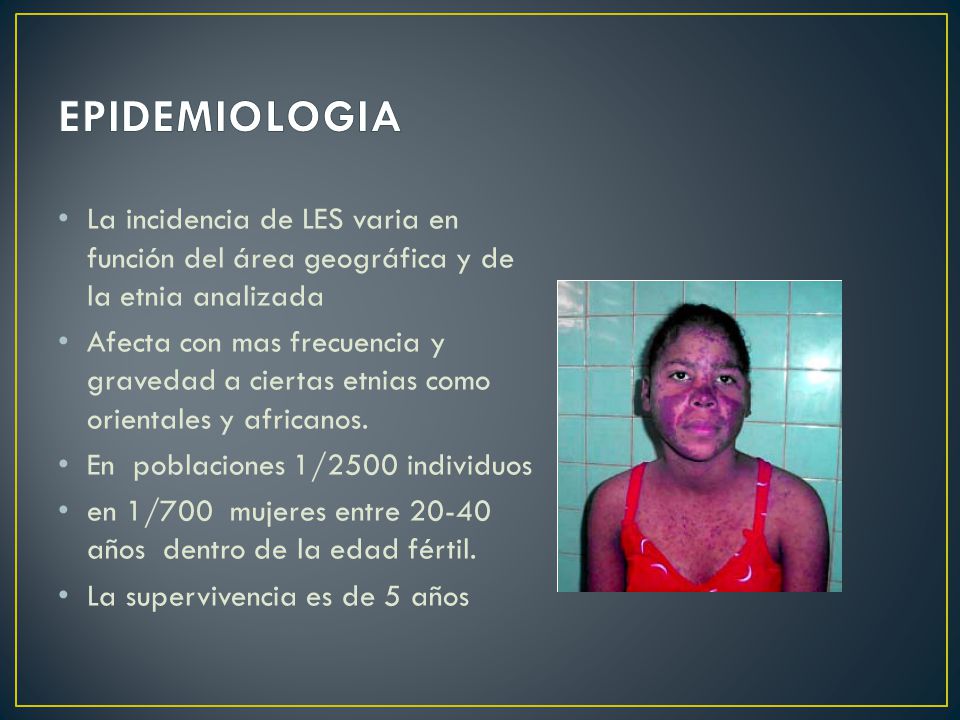 EPIDEMIOLOGIA La incidencia de LES varia en función del área geográfica y de la etnia analizada.