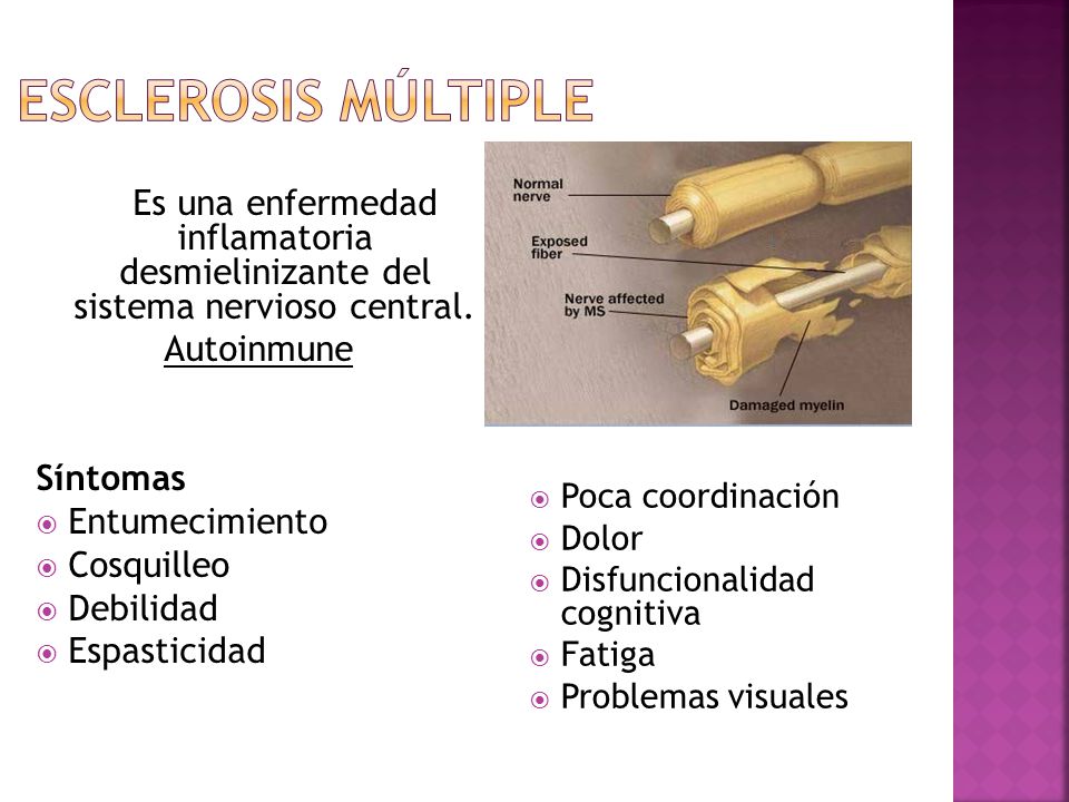 Esclerosis múltiple Es una enfermedad inflamatoria desmielinizante del sistema nervioso central.