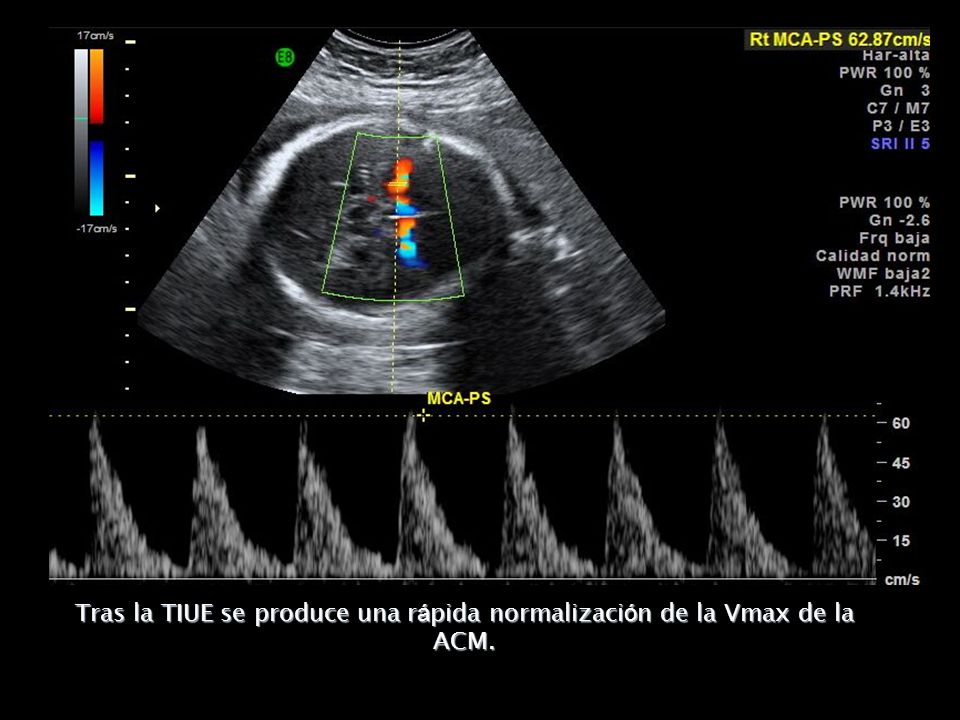 Tras la TIUE se produce una rápida normalización de la Vmax de la ACM.