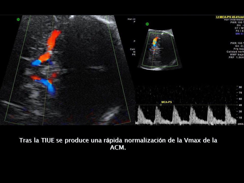 Tras la TIUE se produce una rápida normalización de la Vmax de la ACM.