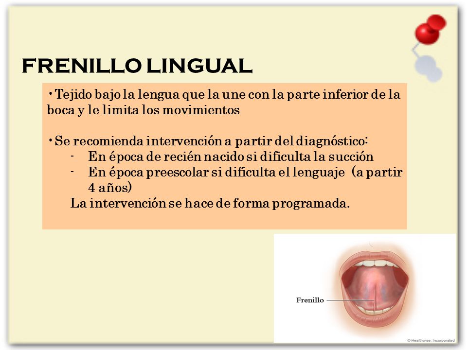 FRENILLO LINGUAL Tejido bajo la lengua que la une con la parte inferior de la boca y le limita los movimientos.