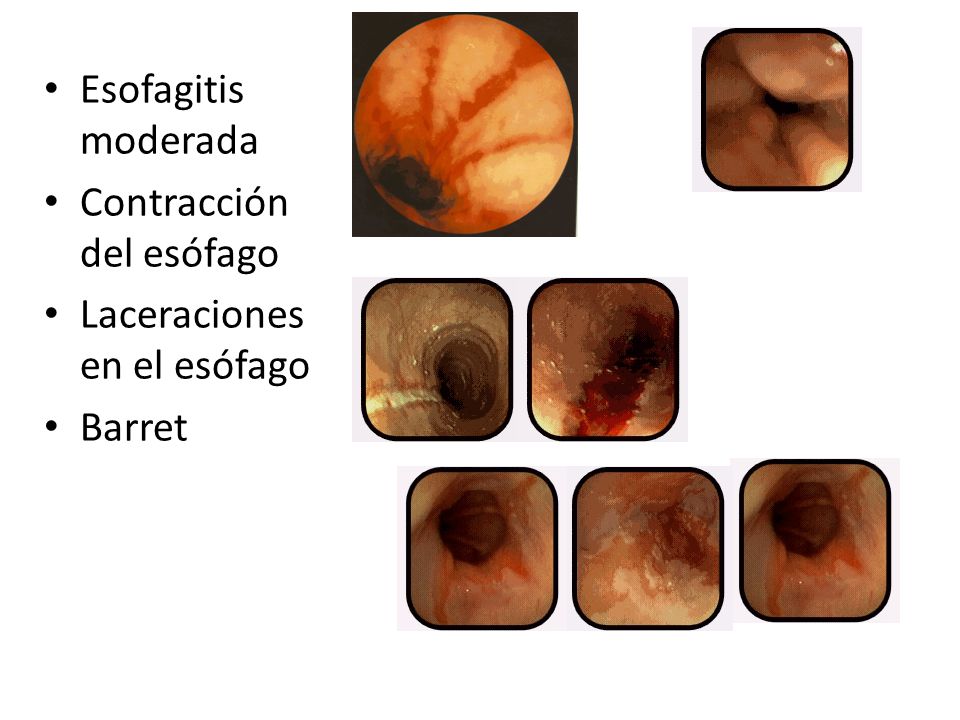 Esofagitis moderada Contracción del esófago Laceraciones en el esófago Barret